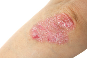 Psoriatic arthritis