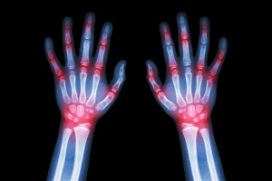 How to tell if you have arthritis
