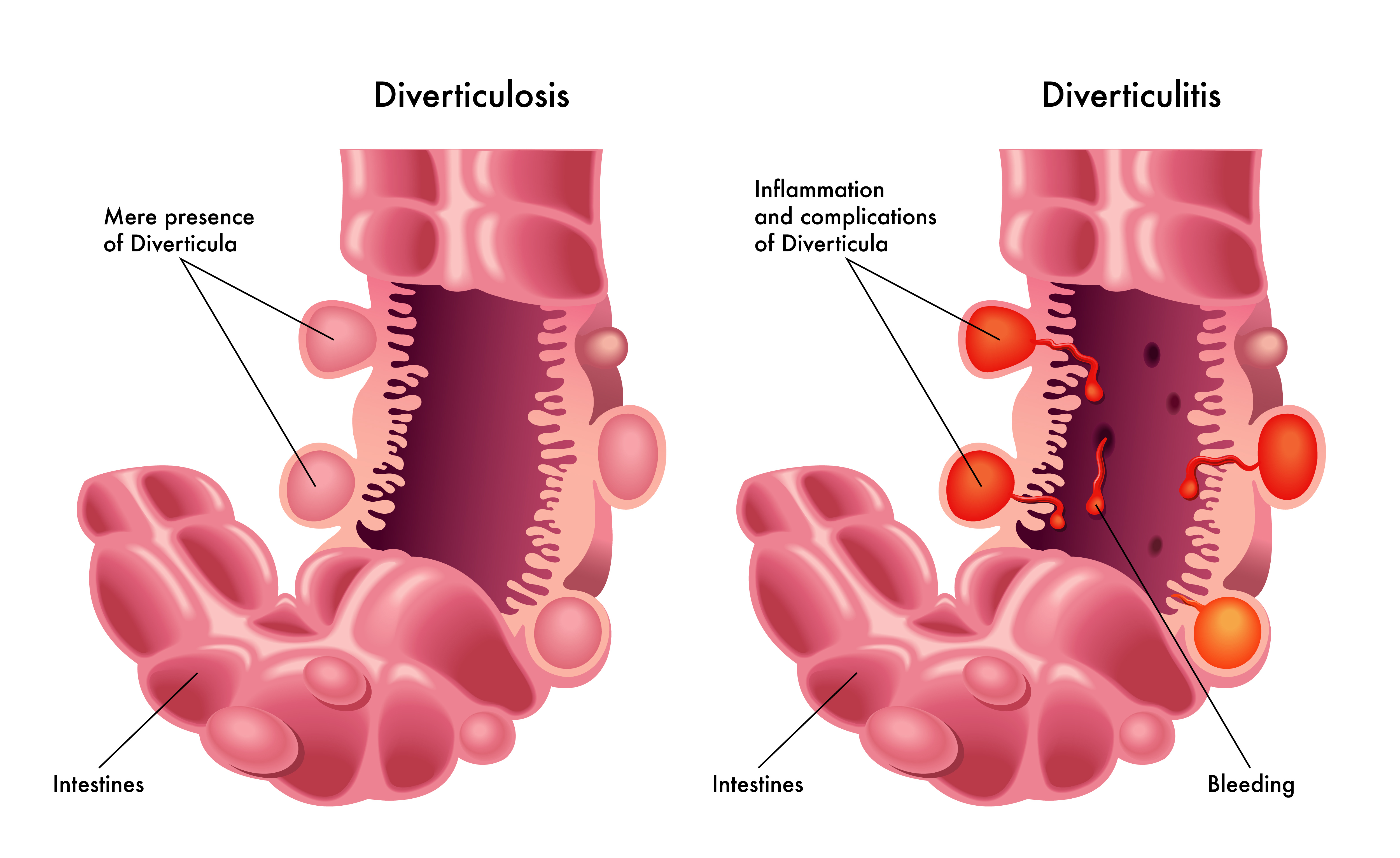 Diverticulitis: More Than Just a Stomach Ache