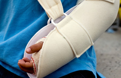 Fractures: Types of Broken Bones in Children