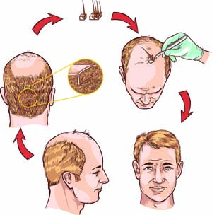 Hair Transplants for Youthful Appearance