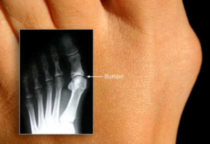 Bunions - ouch…