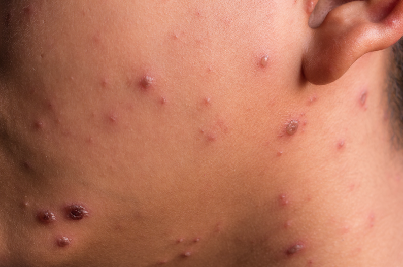 The Chicken Pox – Are You Prepared?